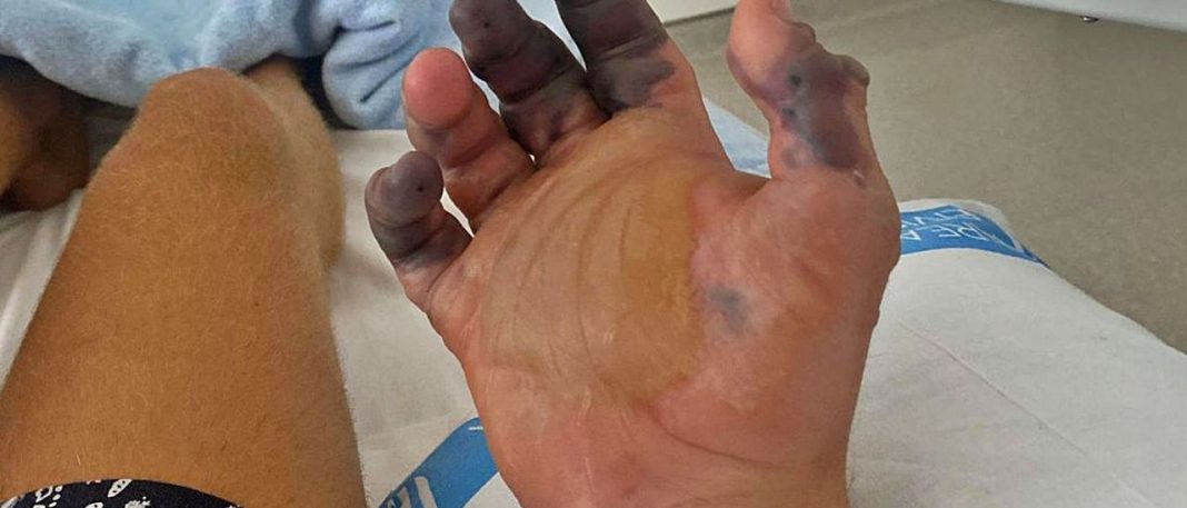 Spider bite in Ibiza leads to amputation of fingers, the first case in Spain