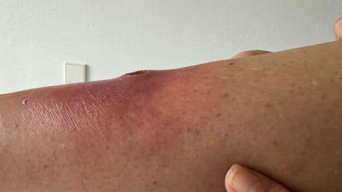 Serious arachnid bite to a French tourist on her arrival in Ibiza