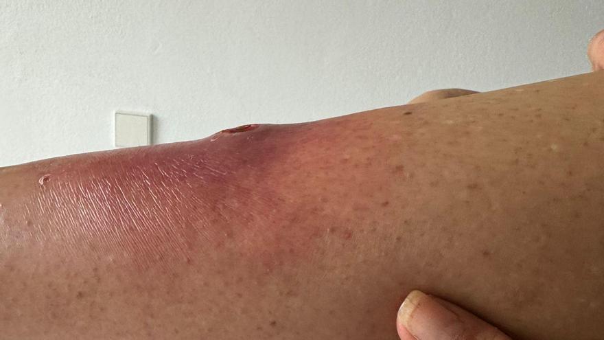 Serious arachnid bite to a French tourist on her arrival in Ibiza
