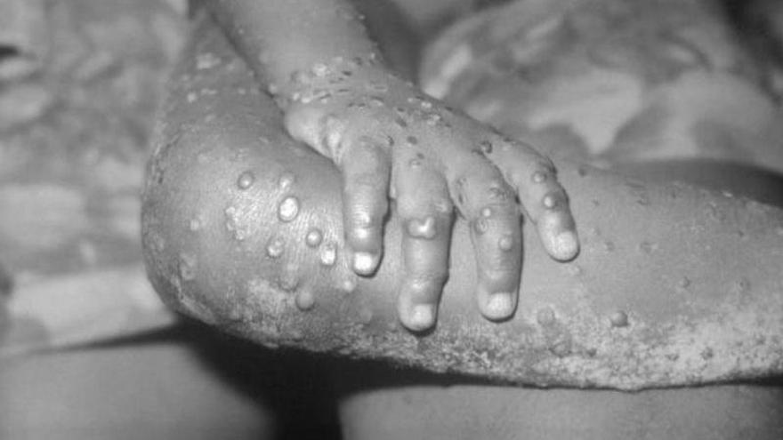 Balearic Islands detects an outbreak of monkeypox: a new variant that has never circulated in the islands has been recorded