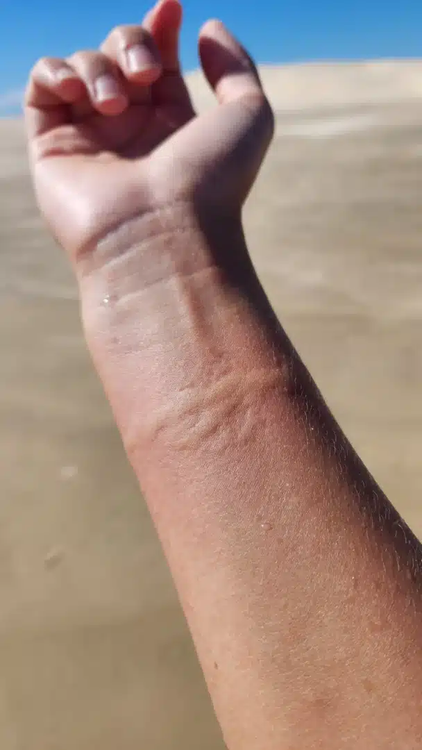 Jellyfish sting